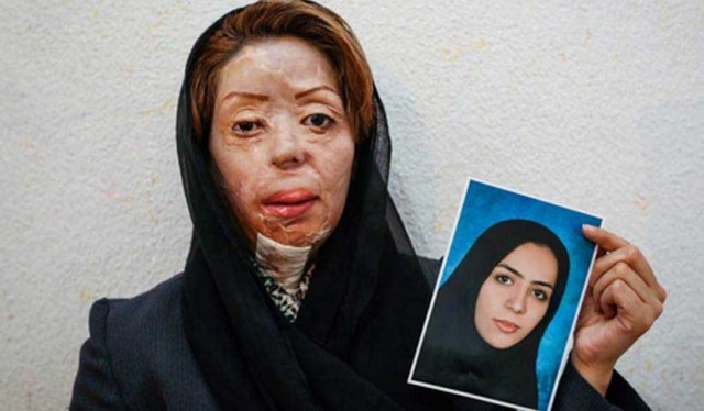 Eines der Opfer von Säureattacken in Isfahan – vorher, nachher!